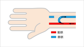 自己静脈内シャント