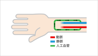 人工血管内シャント